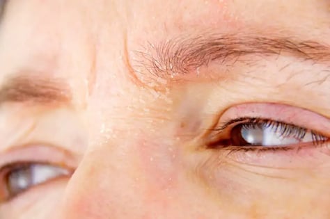 Dermatitis-atopica-cara-mujer3