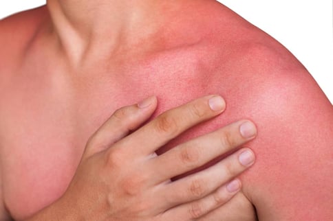 Comment-eviter-que-la-peau-ne-pele-au-soleil-2