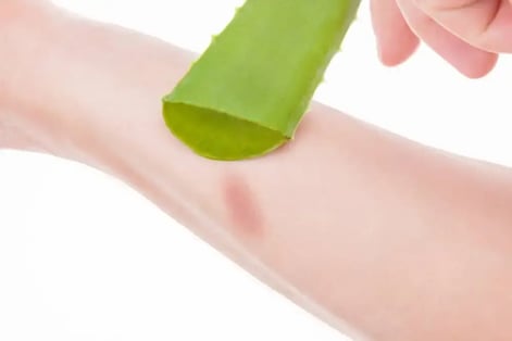 aloe-vera-quemaduras
