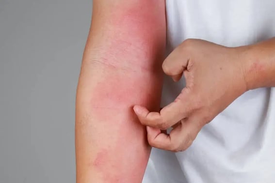 dermatitis-por-estres-brazo