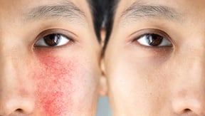 rosacea-estres3