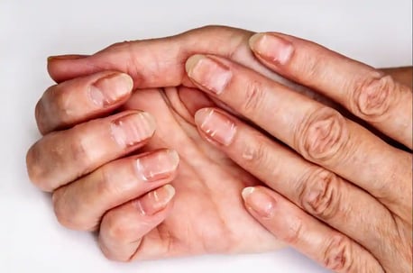 uñas estriadas2