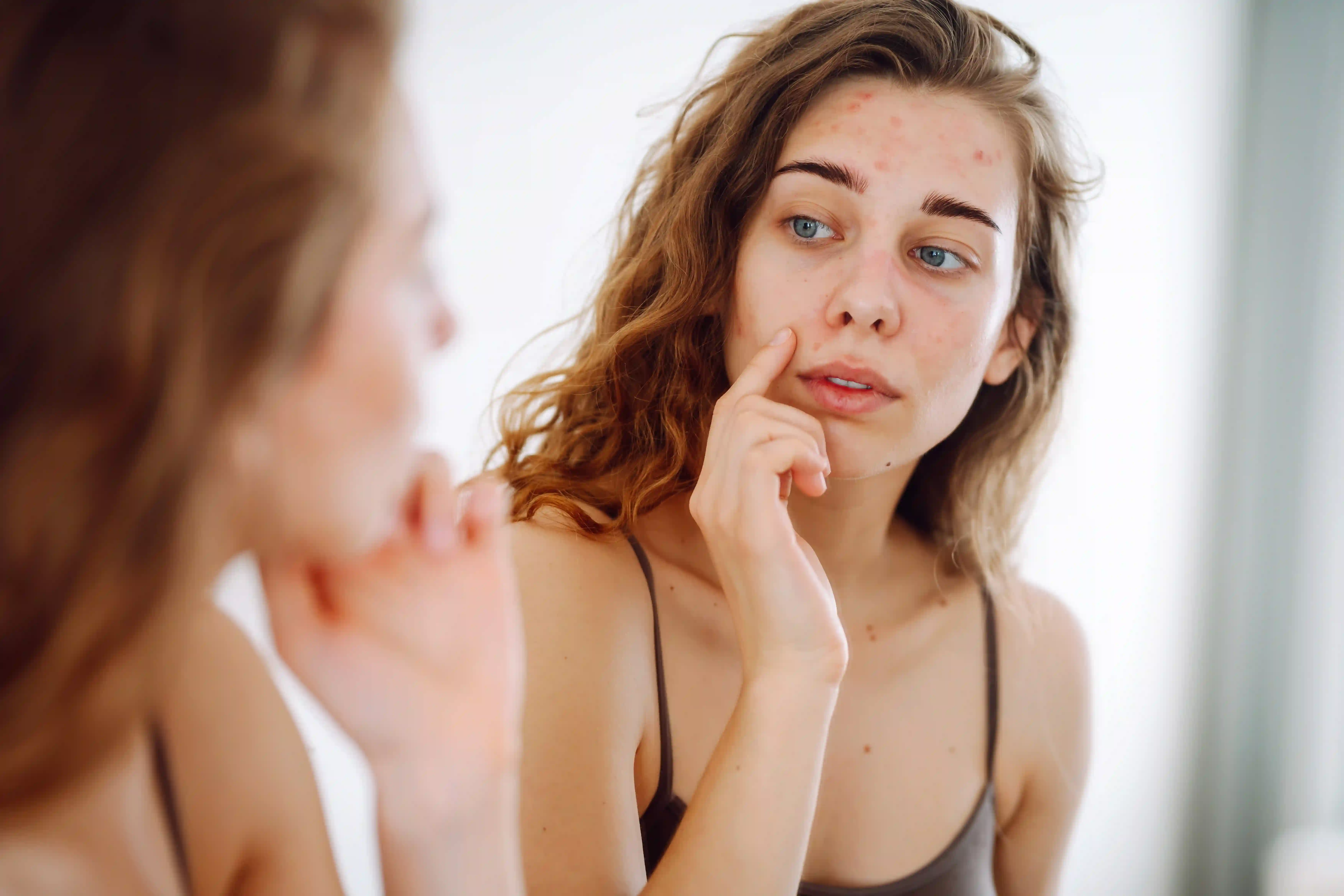 ¿Padeces dermatitis atópica en la cara? Causas y tratamientos