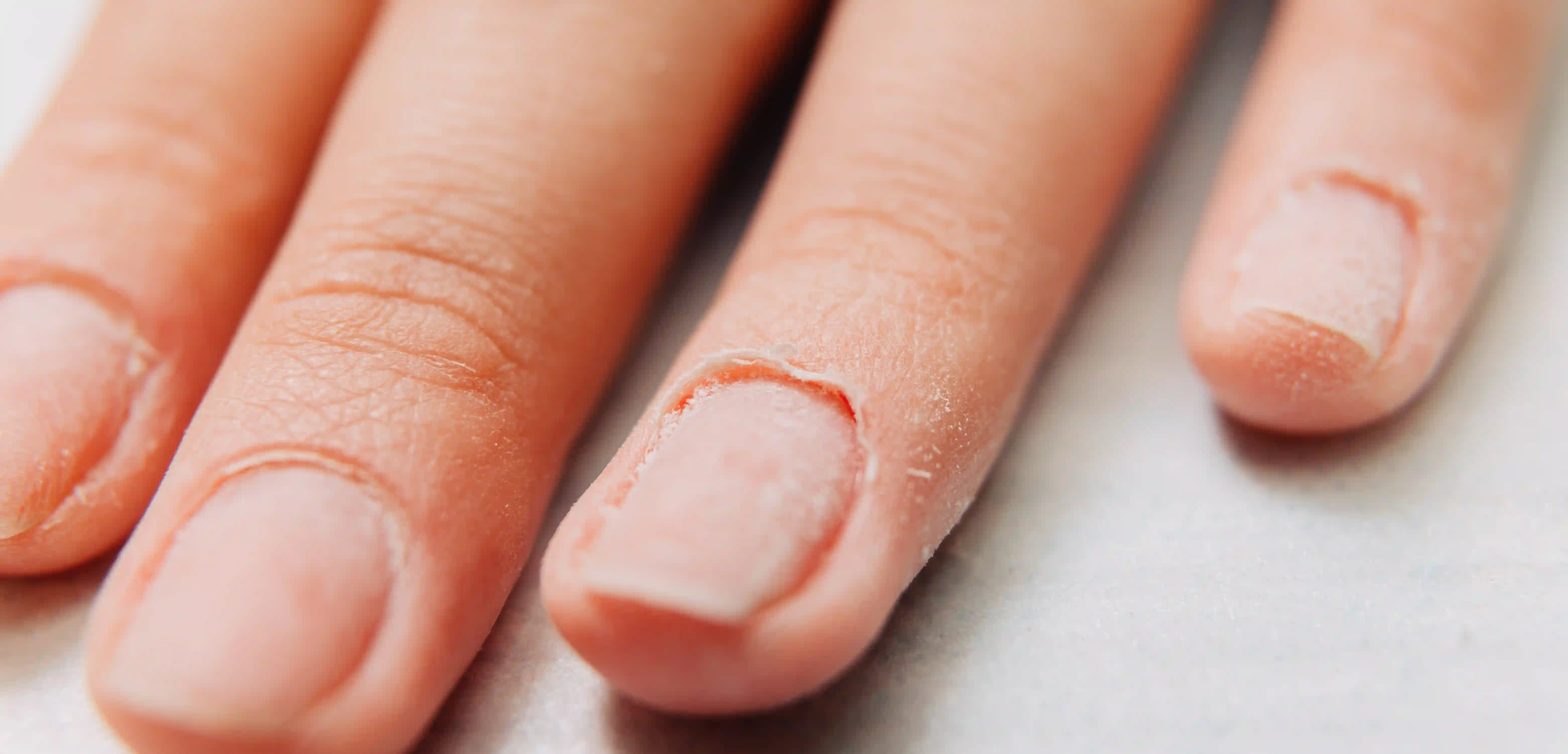 Onicosquicia o fragilidad en las uñas: qué es y cómo tratarla